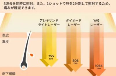 アリシアクリニック熱破壊式脱毛機ラシャトリニティプロの波長