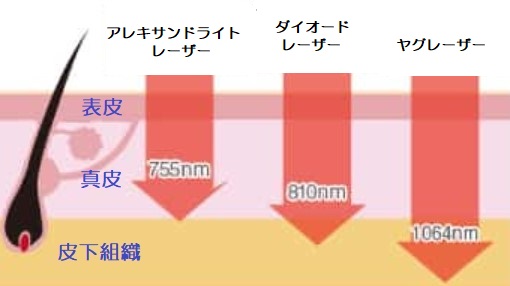 レーザーの種類