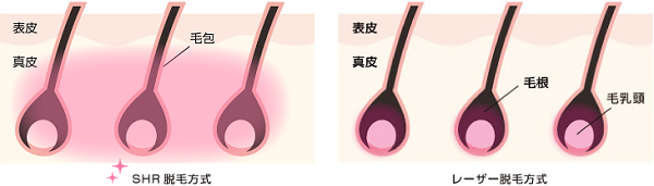 ラココルミクスA9脱毛効果①