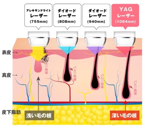 メンズディオクリニック脱毛機波長