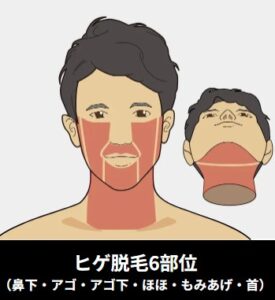 ゴリラクリニックひげ6部位