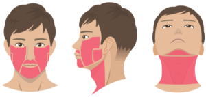 レジーナクリニックオムヒゲ脱毛6部位